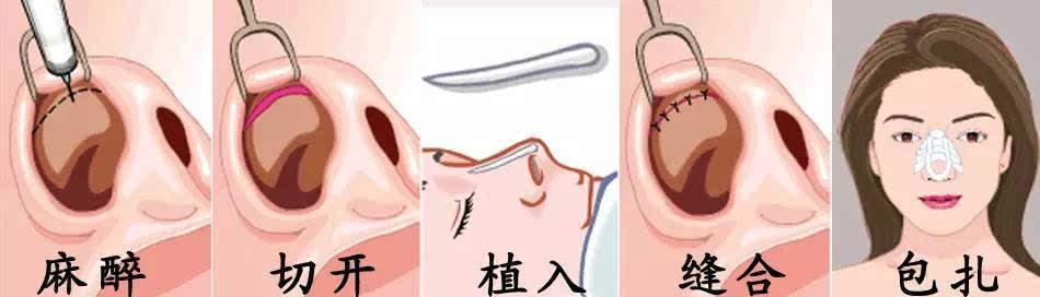隆鼻手術(shù)后有哪些后遺癥呢？