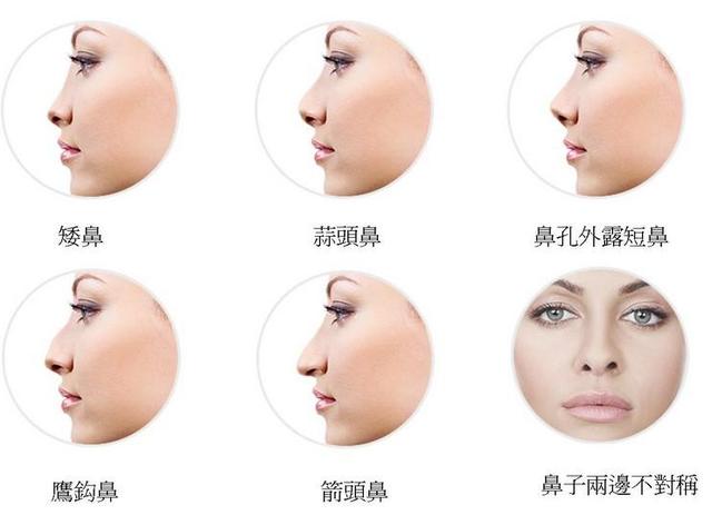 隆鼻手術(shù)后有哪些后遺癥呢？